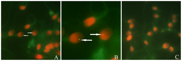 Figure 1 Detection of HIV-1 in spermatozoa by FISH with biotinylated HIV gag and HIV pol probes.